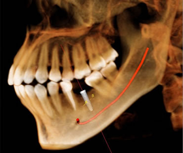 Dental implants Federal Way