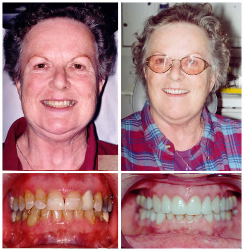 teeth-whitening-and-dental-implant