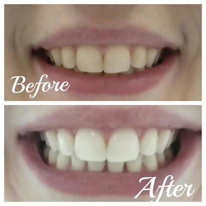 teeth-whitening-and-dental-implant